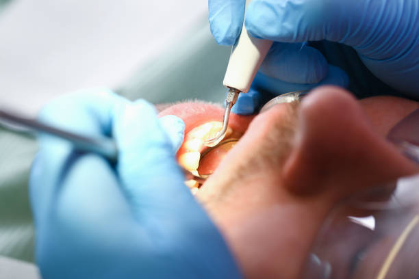Best Emergency Wisdom Tooth Extraction in Kings Bay Base, GA