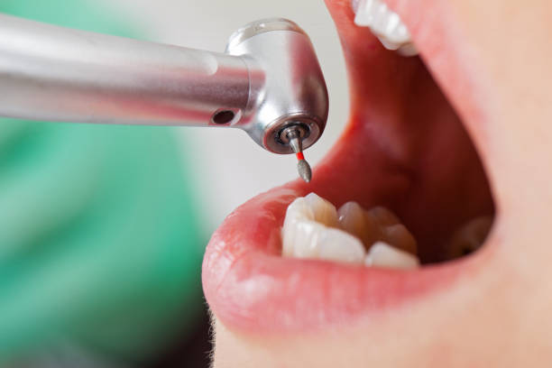Best Knocked-Out Tooth (Avulsed Tooth) Treatment in Kings Bay Base, GA